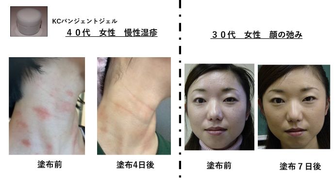 円形脱毛症　病院